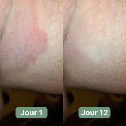 Savon Antifongique Dermeva®